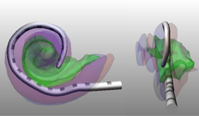 AI Image Processing Demonstrates How to  Precisely Place Cochlear Implants